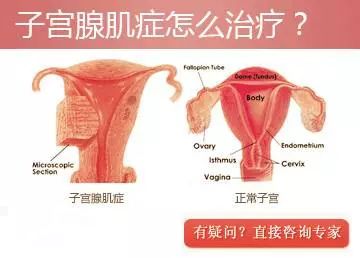 子宫腺肌症最新治疗方法,子宫腺肌症最新治疗方法,照亮女性健康的希望之光,子宫腺肌症最新治疗方法,为女性健康带来希望之光