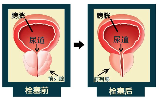 前列腺最新治疗技术,前列腺最新治疗技术，开启健康新篇章，前列腺最新治疗技术，开启健康新篇章之路